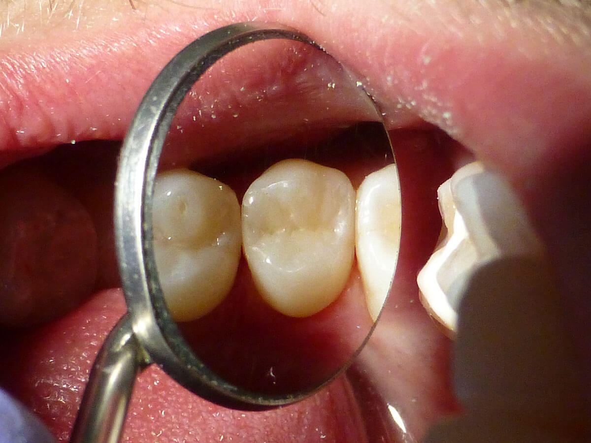 Wypełnienie zęba - po